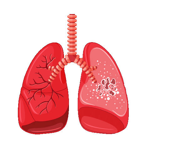 Tuberculosis and Chest diseases 0